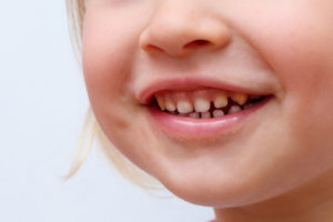 皆さんの子供は笑った時 歯ぐきが見えますか そんな笑顔は何が起きているのでしょうか 幸田町の歯医者 歯科医院 ハピネス歯科 蒲郡 岡崎 幸田